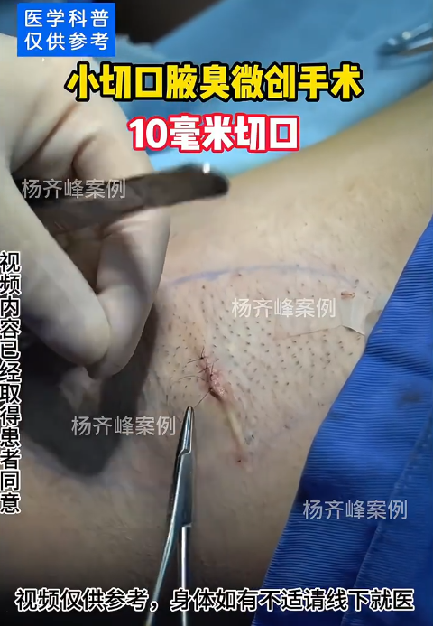 现在最先进的腋臭手术