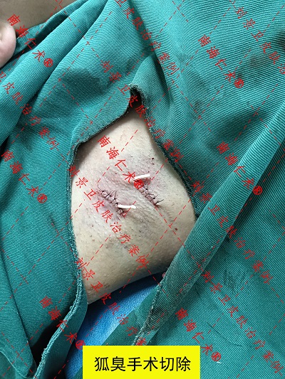 腋臭手术一般多少钱正规医院 腋臭手术一般多少钱正规医院