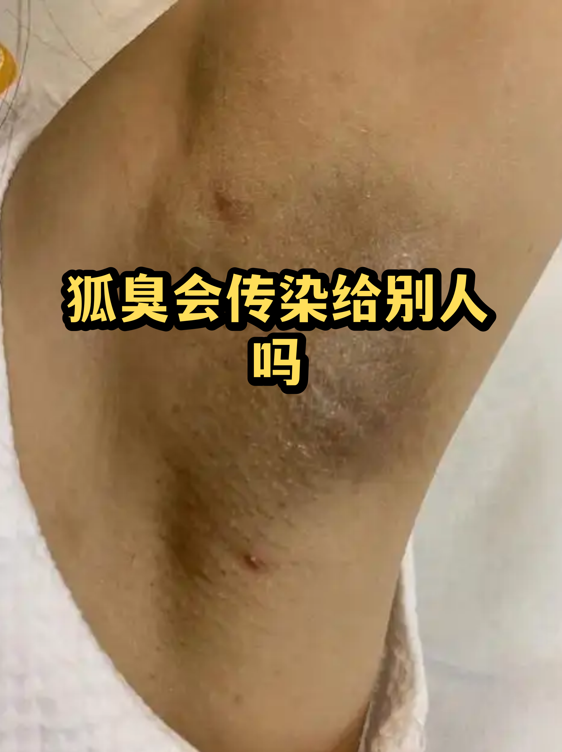 狐臭会性传染吗女