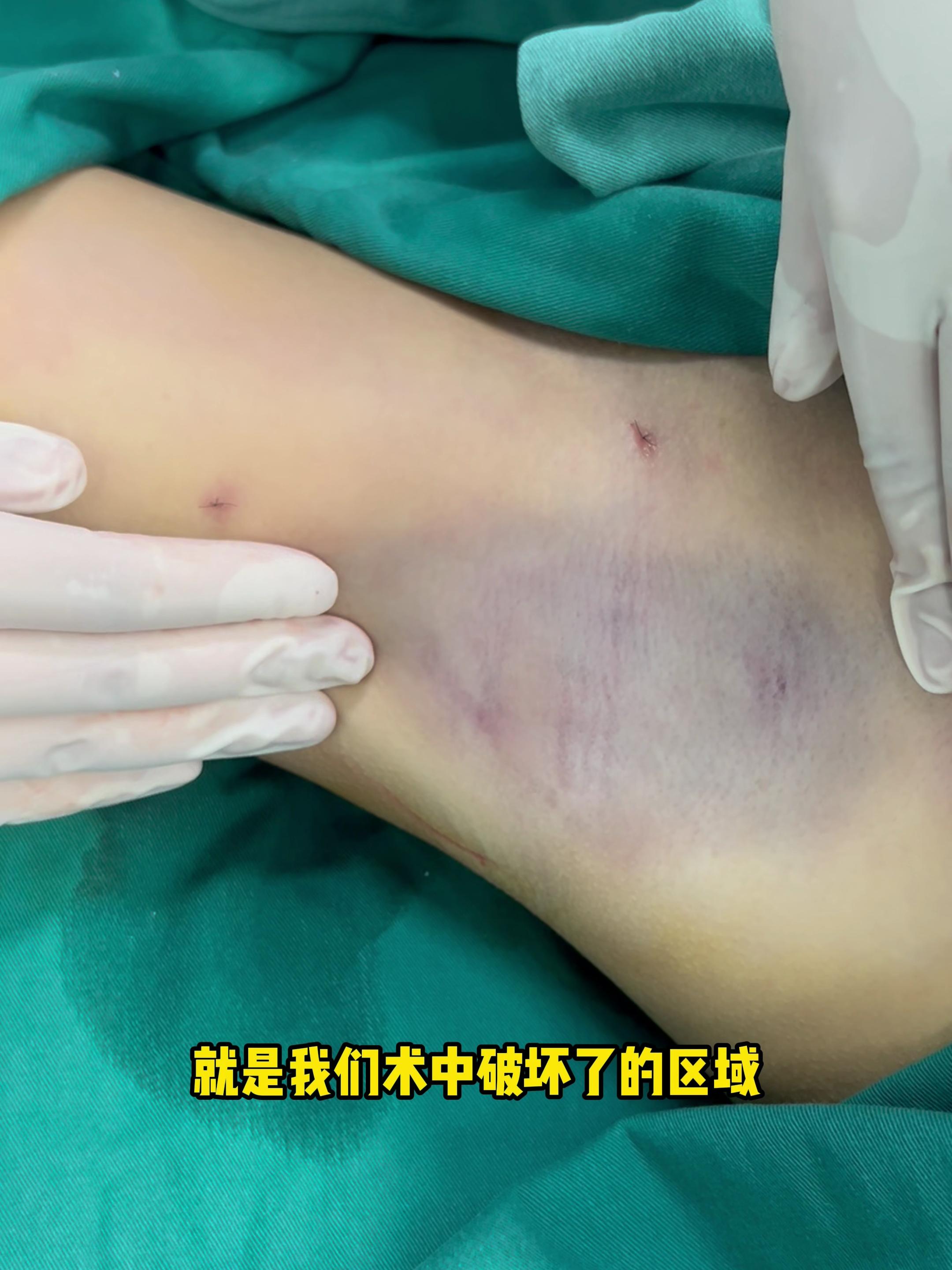 好后悔做了腋臭手术